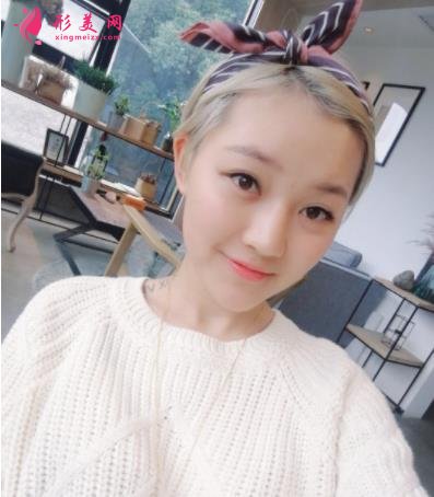 成都润美玉之光整形怎么样?自体脂肪全脸填充案例和真实价格价目分享