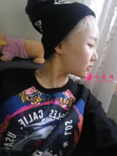 成都润美玉之光整形怎么样?自体脂肪全脸填充案例和真实价格价目分享