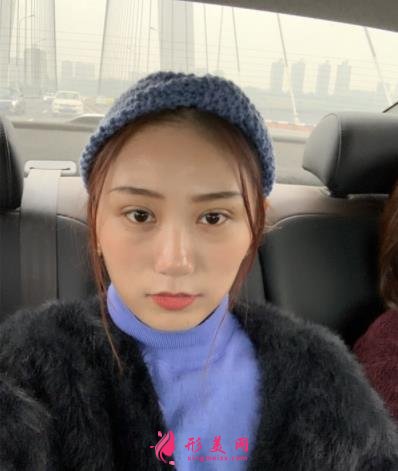 郑东美眼医疗美容怎么样?双眼皮案例效果反馈图及价格费用清单查询