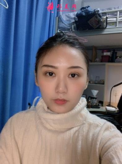 郑东美眼医疗美容怎么样?双眼皮案例效果反馈图及价格费用清单查询