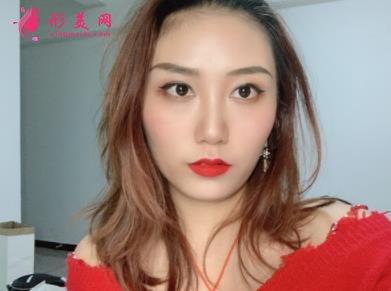 郑东美眼医疗美容怎么样?双眼皮案例效果反馈图及价格费用清单查询