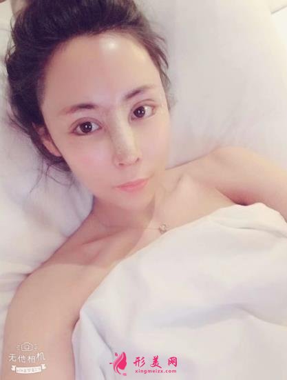 上海伯思立沈国雄鼻修复怎么样?专家案例和价格表参考如下!