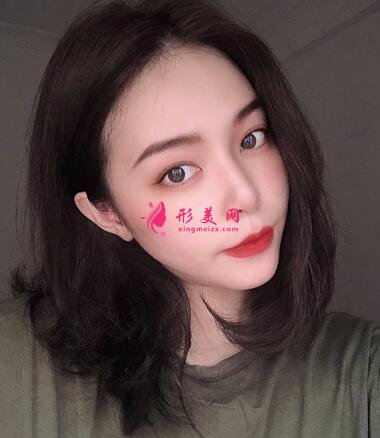 长春海峡整形医院植发咋样?案例效果_价格收费表请查收~