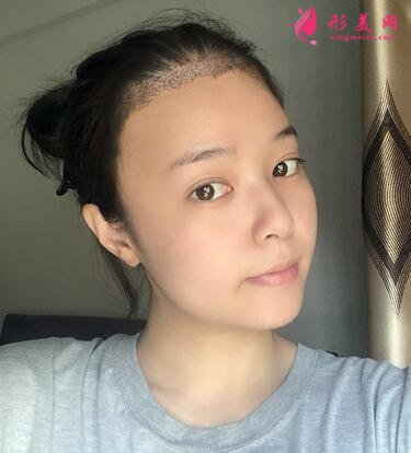 长春海峡整形医院植发咋样?案例效果_价格收费表请查收~