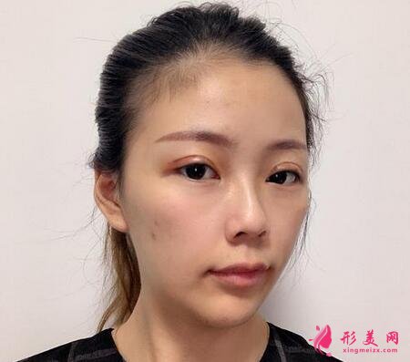 合肥中山医院整形科双眼皮案例反馈!价格价目表收费明细公开~