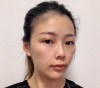 合肥中山医院整形科双眼皮案例反馈！价格价目表收费明细公开~