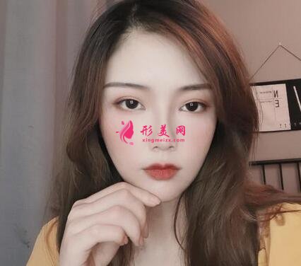 合肥中山医院整形科双眼皮案例反馈!价格价目表收费明细公开~