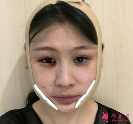 佛山禅城中心医院整形磨骨咋样?案例效果反馈_整形价格同步一览