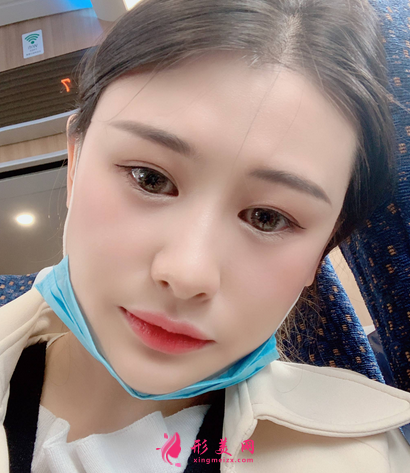 佛山禅城中心医院整形磨骨咋样?案例效果反馈_整形价格同步一览