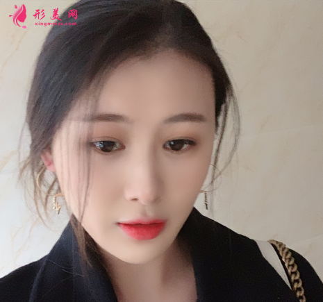 佛山禅城中心医院整形磨骨咋样?案例效果反馈_整形价格同步一览