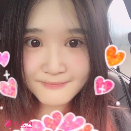 华西整形医院做双眼皮好不好？看专家案例和价格表为你们揭晓！