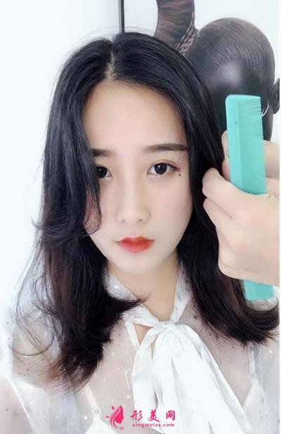 无锡曼陀罗医院上脸下垂矫正案例_整形美容价格表请查收！