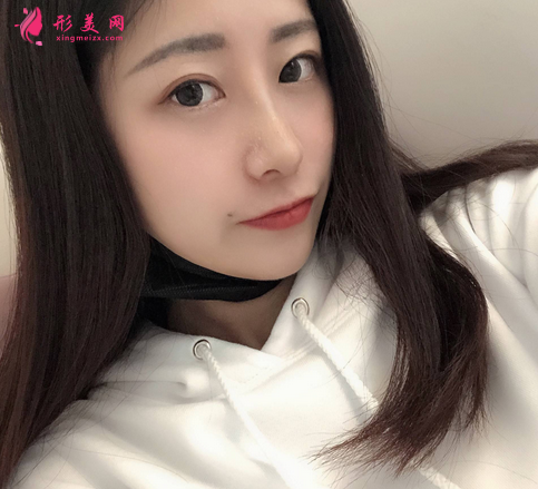 深圳美莱整形美容医院隆鼻案例反馈如下~还有价格收费表明细参考