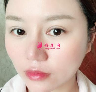 南昌大学二附院整形科去眼袋怎么样？对比下真人案例及价格均价表