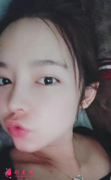 2021上海九院戴传昌做鼻子价格表!在对比真人隆鼻案例实拍