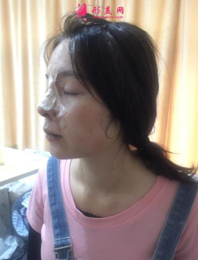 2021上海九院戴传昌做鼻子价格表!在对比真人隆鼻案例实拍