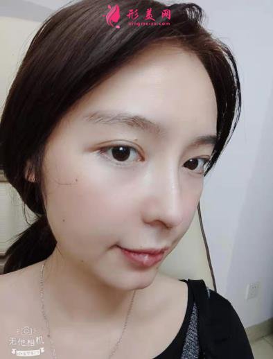 2021上海九院戴传昌做鼻子价格表!在对比真人隆鼻案例实拍