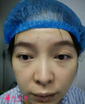 2021上海九院戴传昌做鼻子价格表!在对比真人隆鼻案例实拍