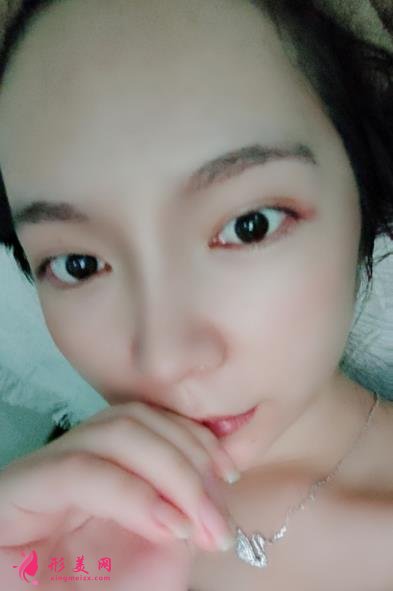 2021上海九院戴传昌做鼻子价格表!在对比真人隆鼻案例实拍