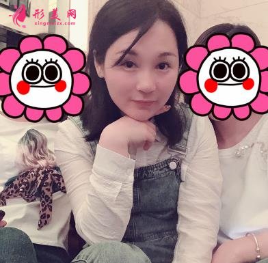 四川华西医院整形科玻尿酸丰太阳穴案例查询！含2021全新价格表公示