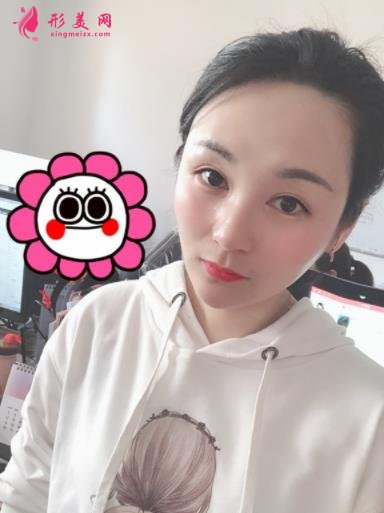 四川华西医院整形科玻尿酸丰太阳穴案例查询！含2021全新价格表公示