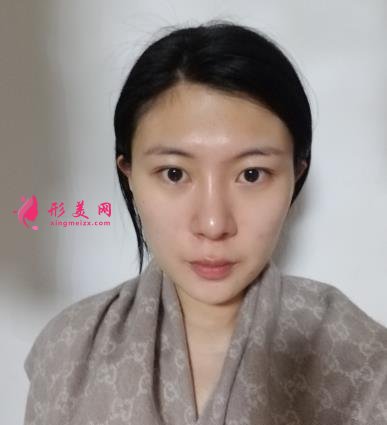 深圳阳光整形医院双眼皮怎么样？效果好吗？手术真实价格费用参考