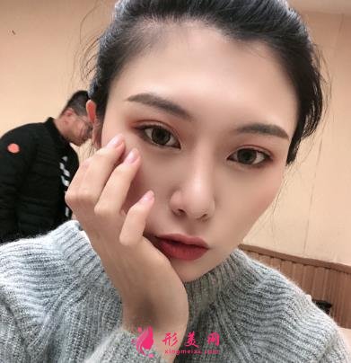 深圳阳光整形医院双眼皮怎么样？效果好吗？手术真实价格费用参考