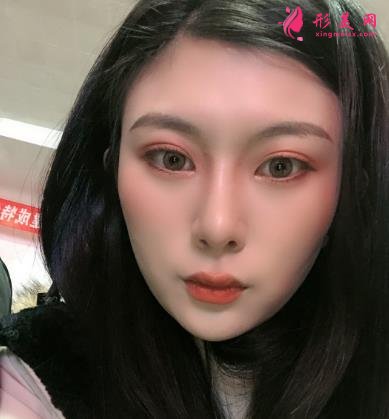 深圳阳光整形医院双眼皮怎么样？效果好吗？手术真实价格费用参考