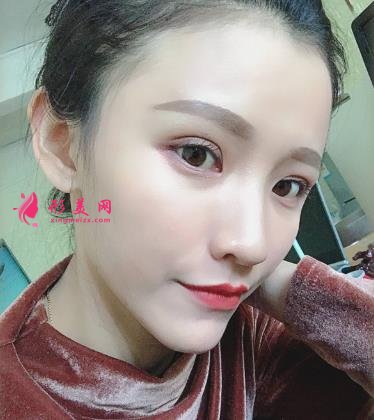 徐州医院双眼皮做得好吗？眼部整形案例及价格情况详细公示