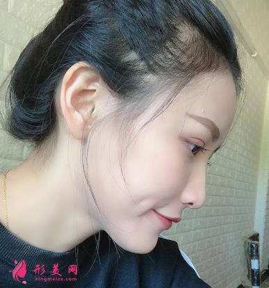 徐州医院双眼皮做得好吗？眼部整形案例及价格情况详细公示