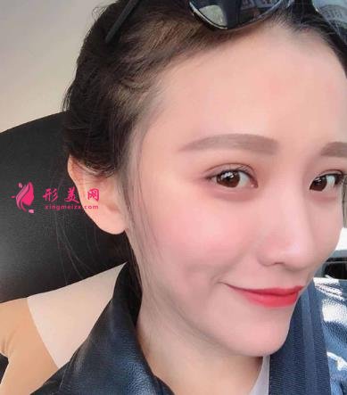 徐州医院双眼皮做得好吗？眼部整形案例及价格情况详细公示