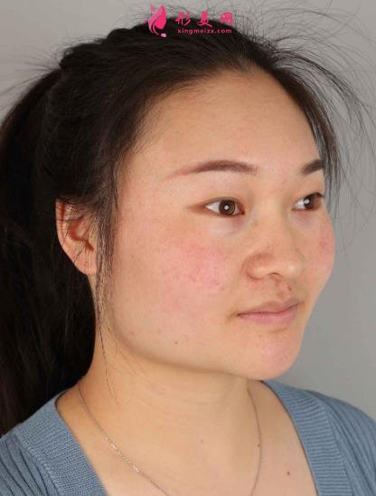 西安国际医学中心整形医院怎么样？下颌角削骨案例及价格表2021均价一览