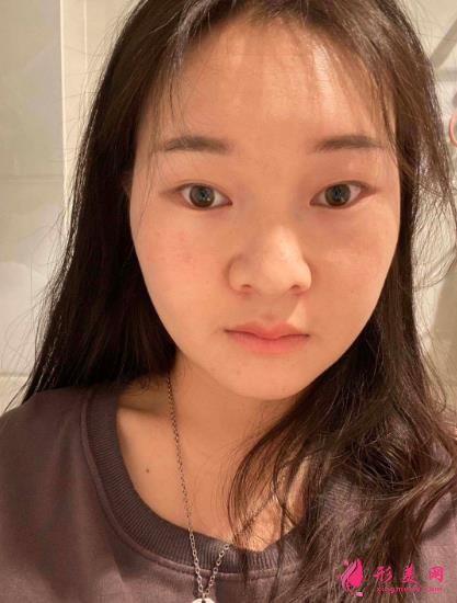 西安国际医学中心整形医院怎么样？下颌角削骨案例及价格表2021均价一览