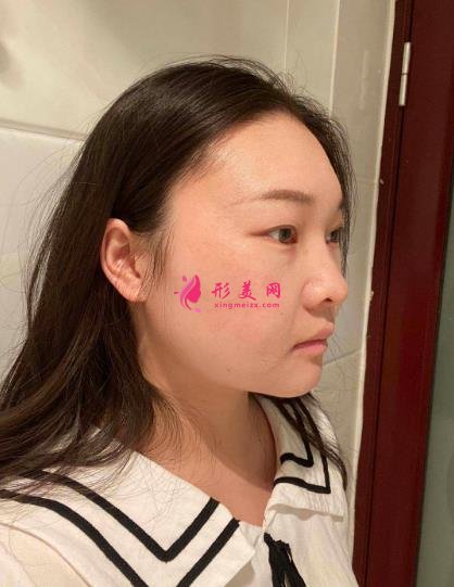 西安国际医学中心整形医院怎么样？下颌角削骨案例及价格表2021均价一览