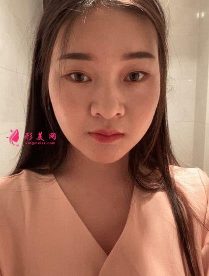 西安国际医学中心整形医院怎么样？下颌角削骨案例及价格表2021均价一览