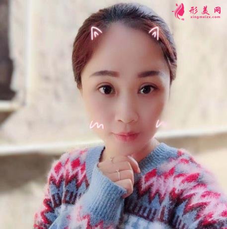 深圳北大医院整形科做双眼皮怎么样？案例及价格表（多少钱）在线参考