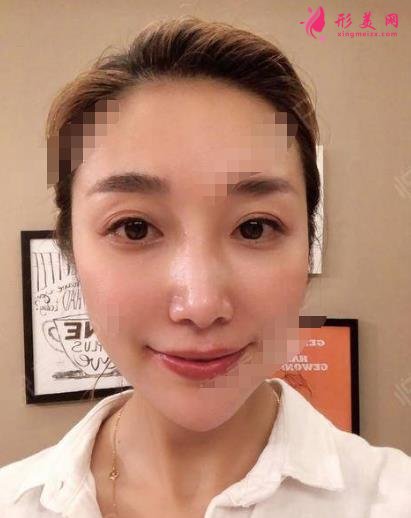 衡水整形医院哪家好？排名前三口碑推荐_含除皱（颈纹）案例效果图