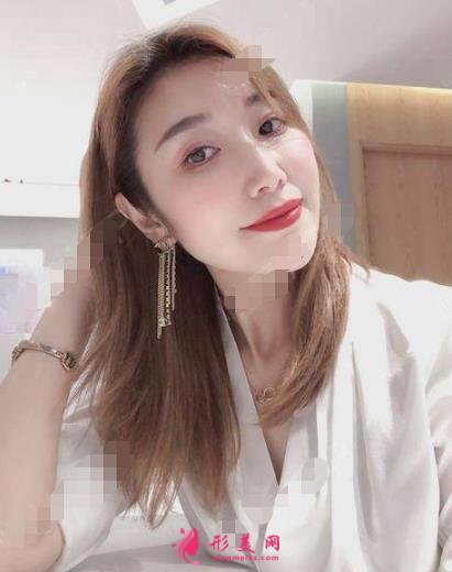 衡水整形医院哪家好？排名前三口碑推荐_含除皱（颈纹）案例效果图