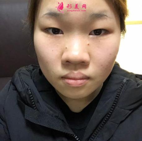 济南千佛山医院整形科怎么样?附双眼皮恢复过程图一览