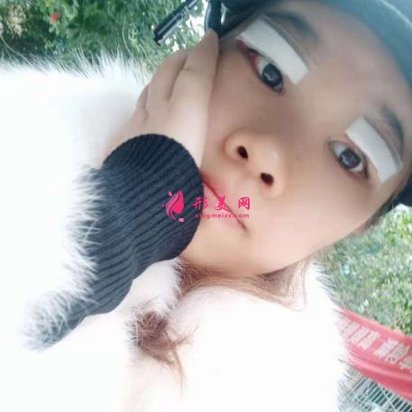济南千佛山医院整形科怎么样?附双眼皮恢复过程图一览