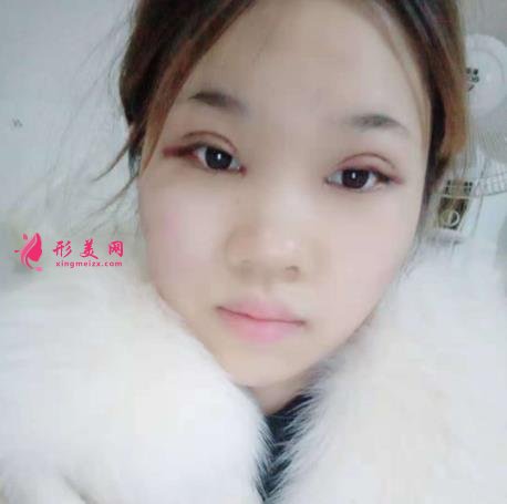 济南千佛山医院整形科怎么样?附双眼皮恢复过程图一览