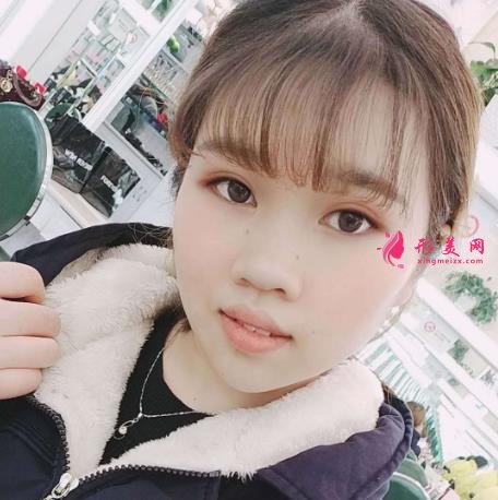 济南千佛山医院整形科怎么样?附双眼皮恢复过程图一览