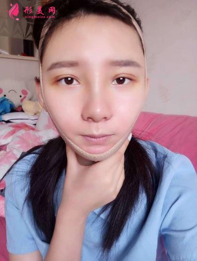 武汉同济整形科怎么样?做磨骨口碑案例~~恢复照片记录反馈