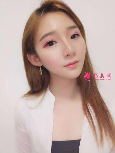 武汉同济整形科怎么样?做磨骨口碑案例~~恢复照片记录反馈