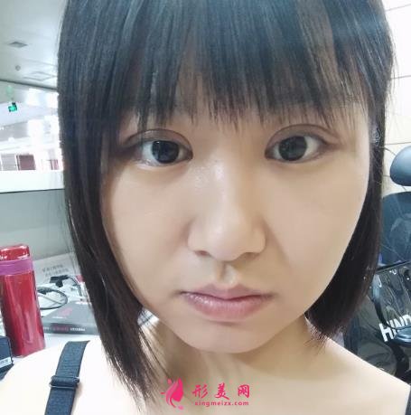 延安市人民医院整形科怎么样?2021双眼皮手术恢复过程图分享