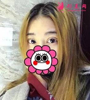 唐山金荣是三甲医院吗?双眼皮案例及价格表一览!