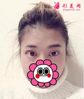 唐山金荣是三甲医院吗?双眼皮案例及价格表一览!