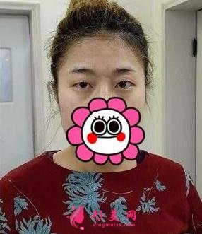 唐山金荣是三甲医院吗?双眼皮案例及价格表一览!