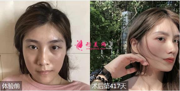 南京鼓楼医院整形科医生排名_案例对比图_2020价格表全面公布!