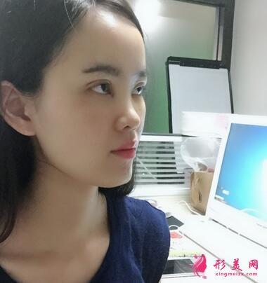重庆市中山医院整形美容科价格表,附隆鼻案例效果对比图